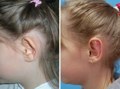 Ohren anlegen Vorher - Nachher / Seitenansicht links