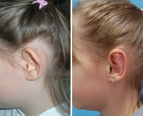 Ohren anlegen Vorher - Nachher / Seitenansicht links