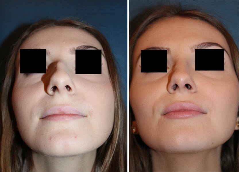 Nasenkorrektur Nasensteg vorher-nachher