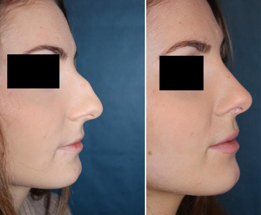 Vorher Nachher Bilder von Nasenkorrekturen, Nasen OP’s, Nasenspitzenkorrekt...