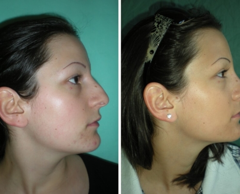 Nasenkorrektur Vorher - Nachher nach 2 Monaten