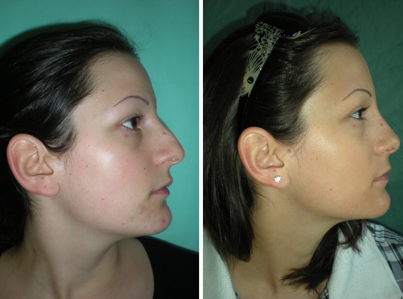 Nasenkorrektur Vorher - Nachher nach 2 Monaten