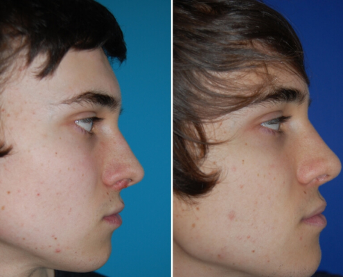 Nasenkorrektur Vorher - Nachher 2 Monate nach offener Nasenscheidewandkorrektur