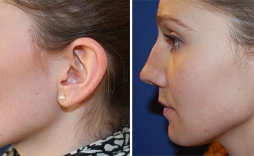 Ohrenkorrektur Vorher - Nachher / Seitenansicht