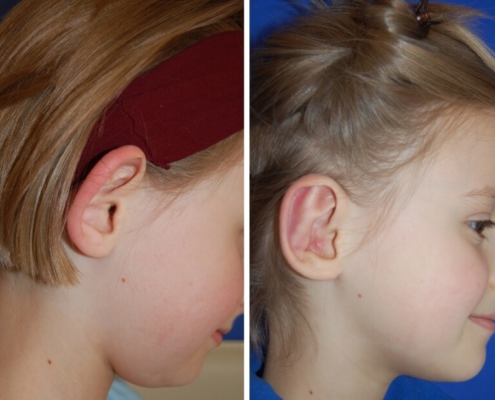Ohrenkorrektur Vorher - Nachher nach 2 Monaten / Seitenansicht rechts