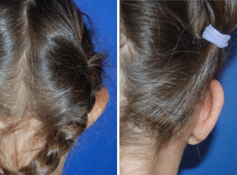Ohrenkorrektur Vorher - Nachher nach 2 Monaten / Vorderansicht