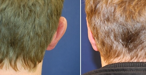 Ohrenkorrektur Vorher-Nachher / hinterkopf
