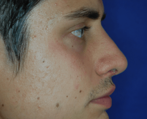 Patientenbegleitung Nasenkorrektur / 6 Wochen nach der Operation