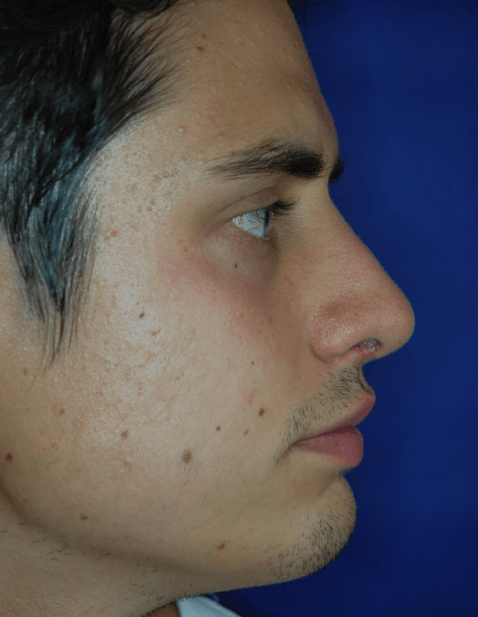 Patientenbegleitung Nasenkorrektur / 6 Wochen nach der Operation