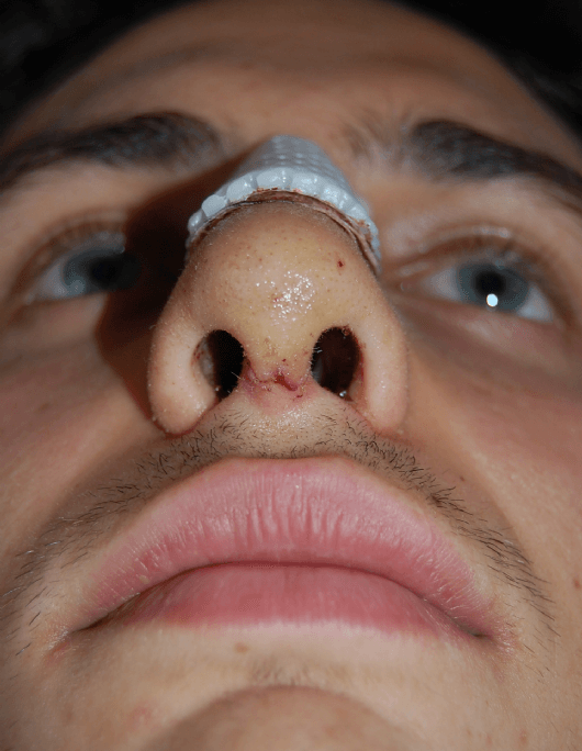 Patientenbegleitung Nasenkorrektur / 7. Tag nach der Operation