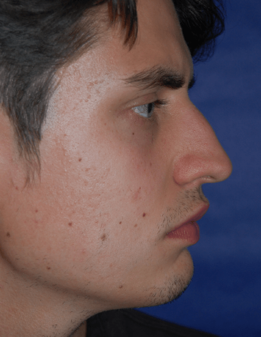 Patientenbegleitung Nasenoperation