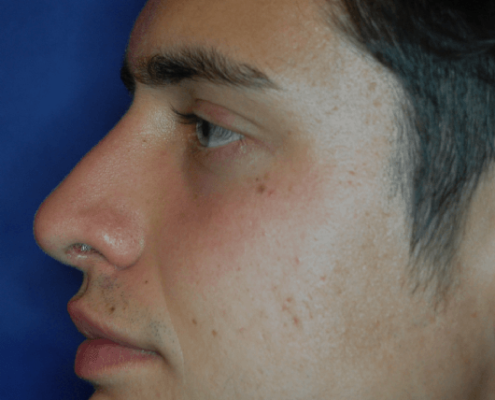 Patientenbegleitung Nasenkorrektur / 3 Monate nach der Operation
