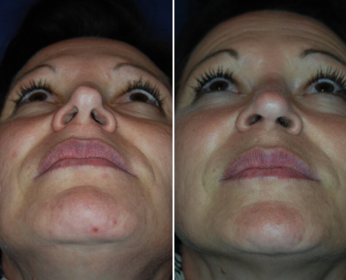 Nasenkorrektur Vorher - Nachher 3 Monate nach Wiederaufbau mit körpereigenem Knorpel