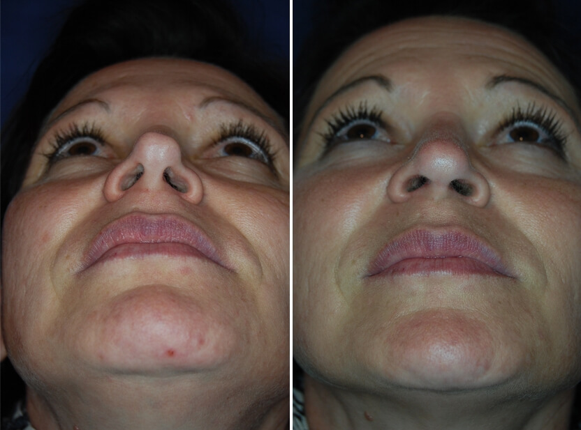 Nasenkorrektur Vorher - Nachher 3 Monate nach Wiederaufbau mit körpereigenem Knorpel