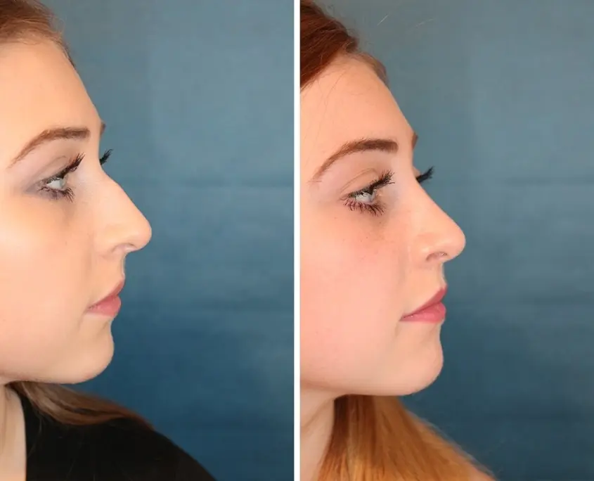 Nasen OP VorherNachher Dr. Pichelmaier, Wien