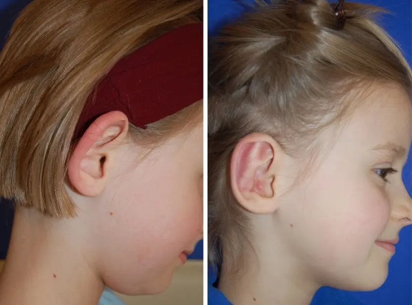 DEWIN Ohr Korrektor Patch - Silikon Pflaster Gegen Abstehende Ohren