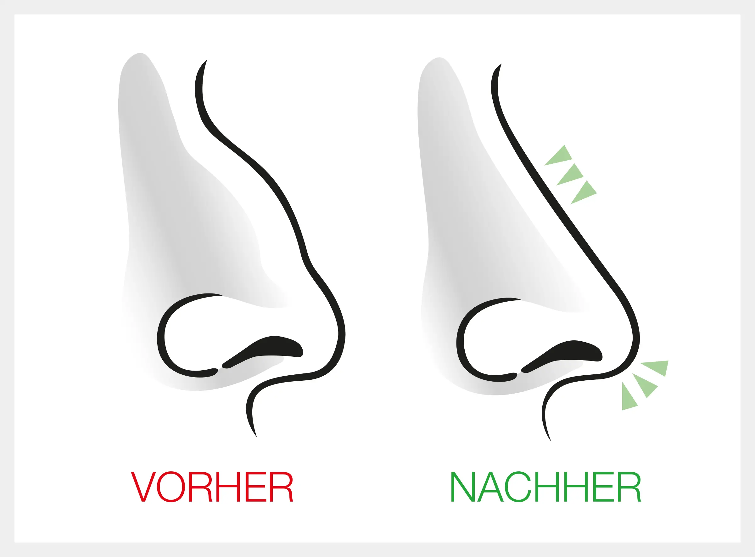 Nasenscheidewand OP Septumplastik Dr. Pichelmaier, Wien