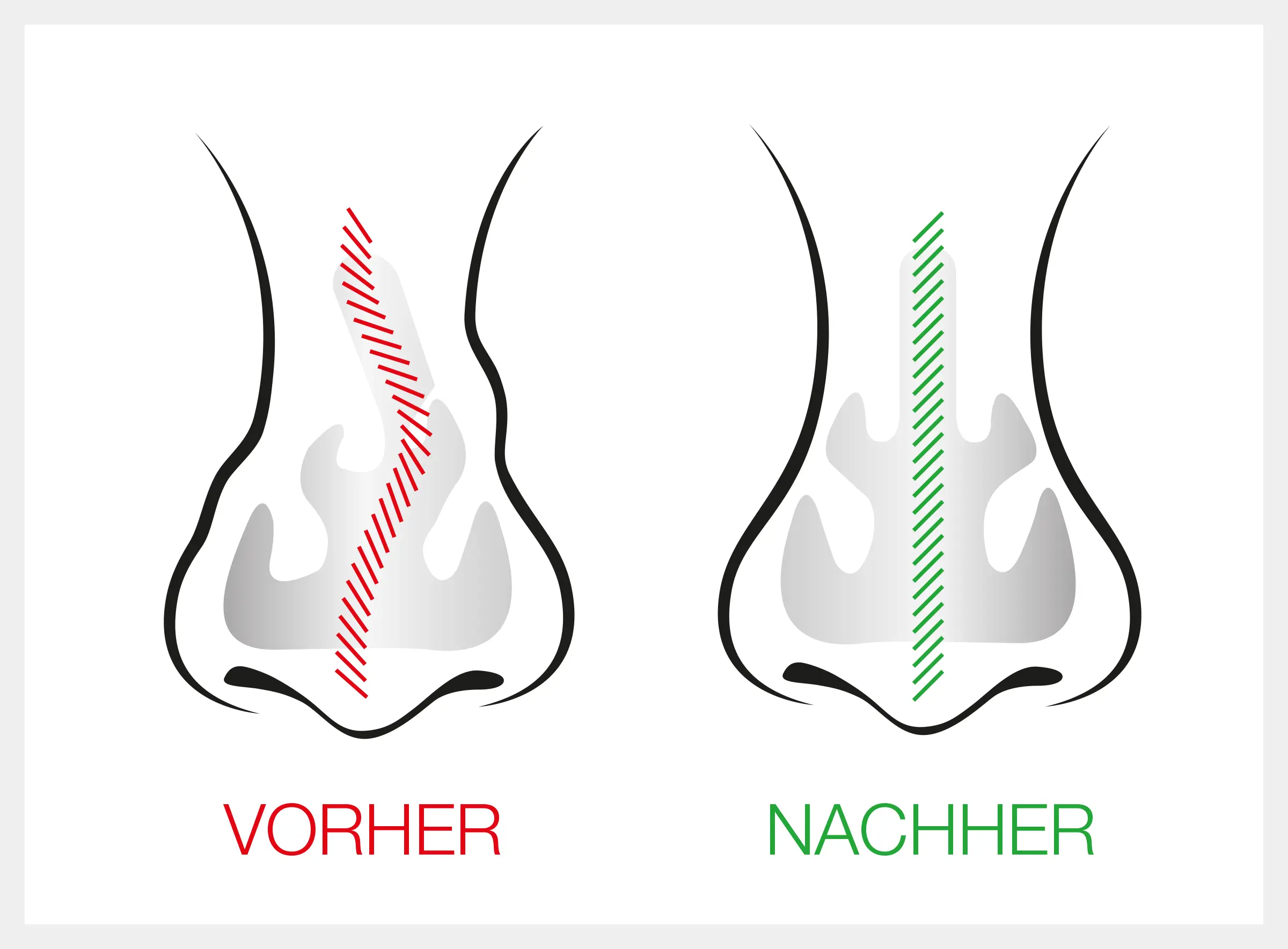 Nasenscheidewand OP Septumplastik Dr. Pichelmaier, Wien