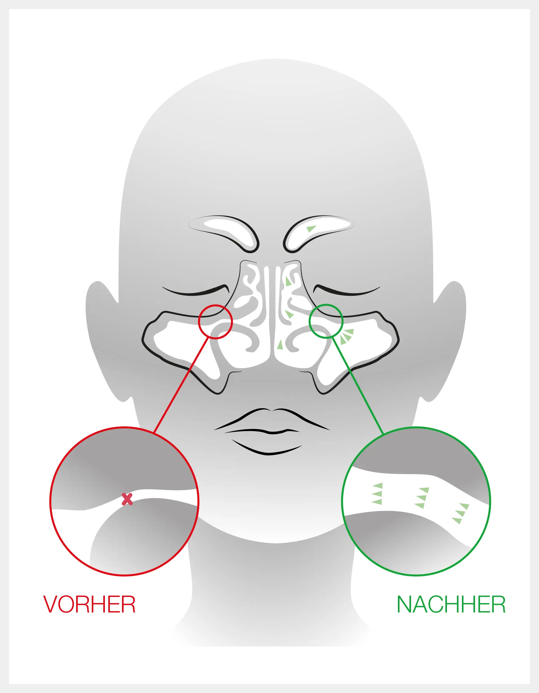 Nasen-OP Nasenchirurgie