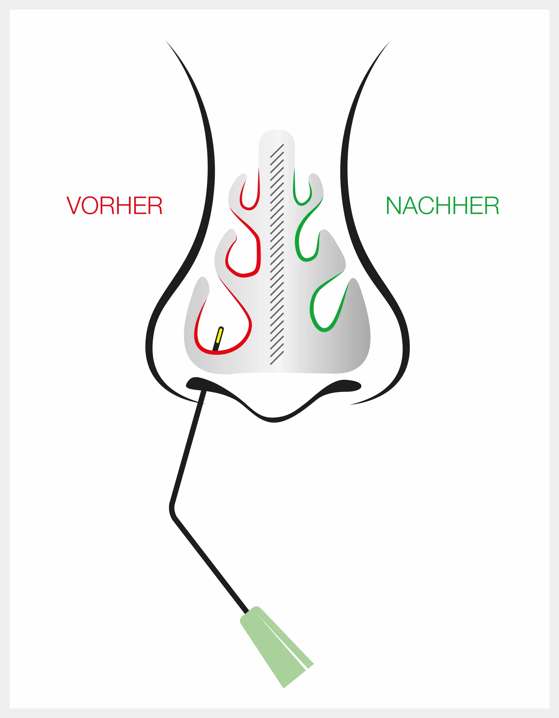 Nasenmuschel-Verkleinerung