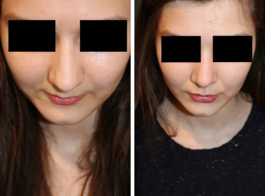 Nasenkorrektur Vorher - Nachher nach 5 Wochen