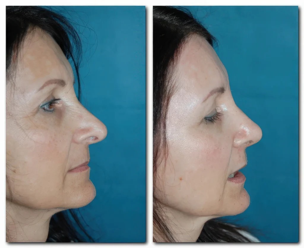 Asymmetrische überlange Nasenspitze