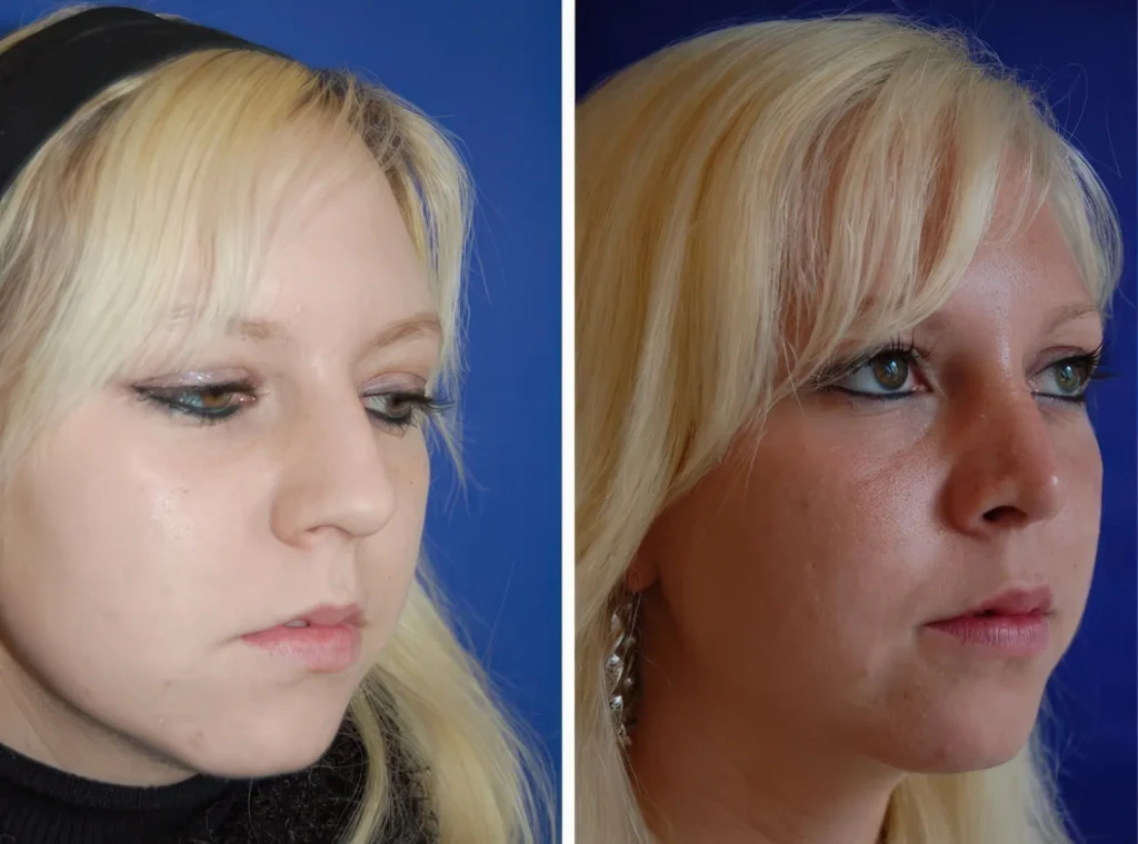 Rhinoplastik
