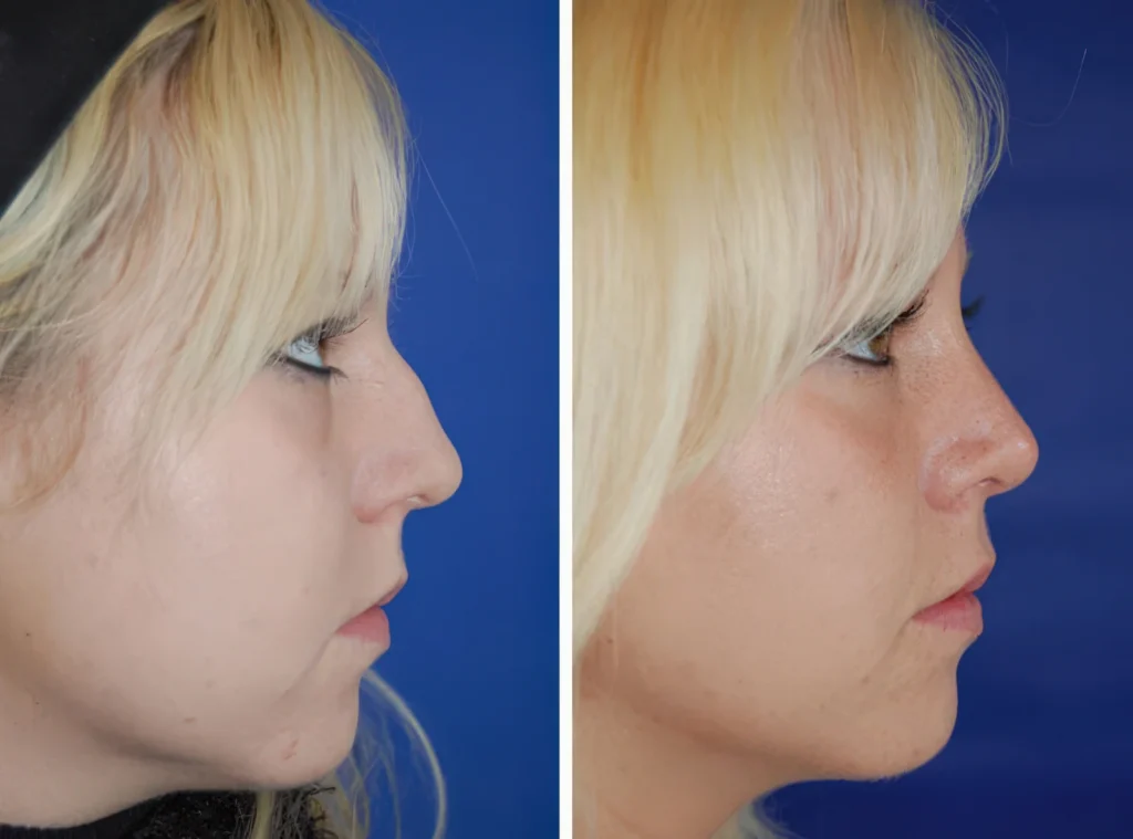 Septorhinoplastik