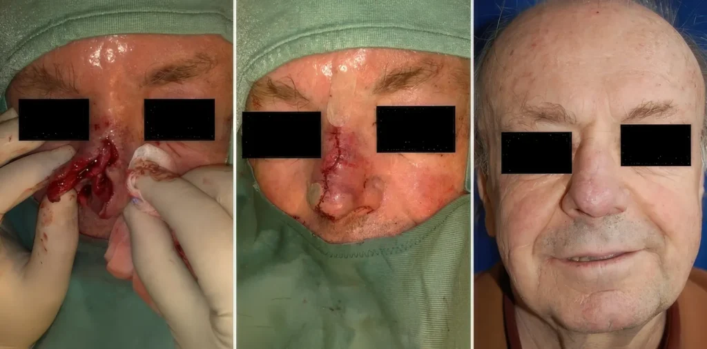 2 Monate postoperativ nach Rekonstruktion des knorpeligen Nasengerüstes