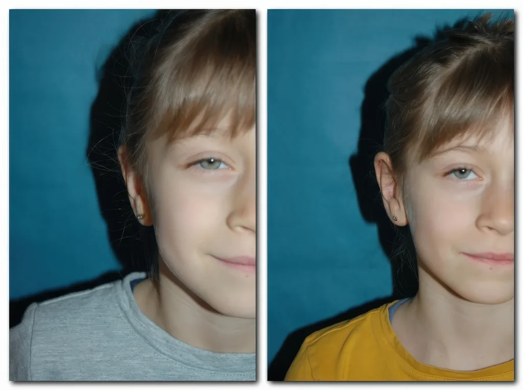 Ohranlegeplastik vorne rechts