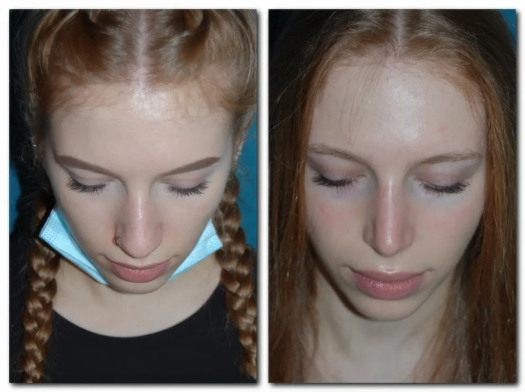 Nasen OP Septumdeviation